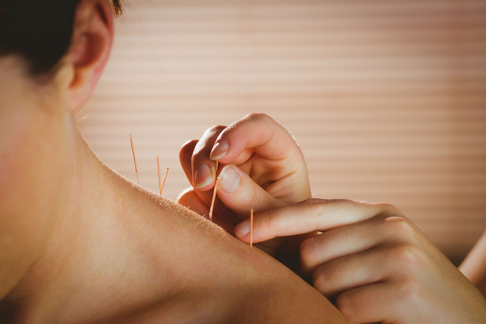 Clinical Acupuncture therapy at Seva Physical Therapy NYC